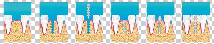 Dental Implant Dentistry Surgery Bridge PNG, Clipart, Blue, Bridge, Computer Wallpaper, Crown, Dental Implant Free PNG Download