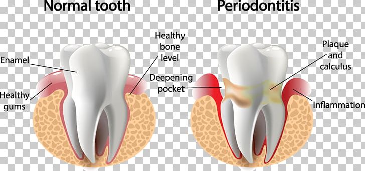 Periodontal Disease Gums Gingivitis Periodontology Dentistry PNG, Clipart, Dental Public Health, Dentist, Dentistry, Disease, Ear Free PNG Download