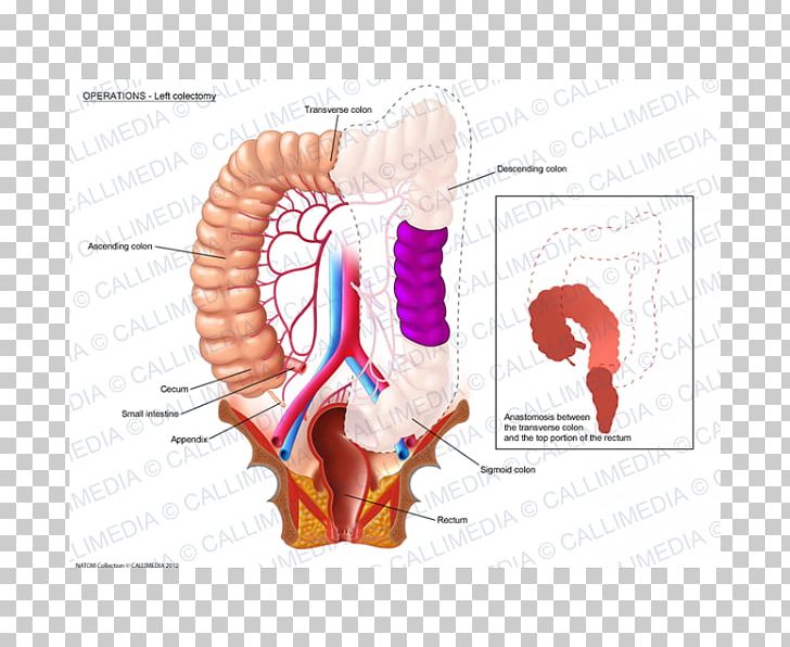 Colectomy Colorectal Cancer Rectum Lymph Node Surgery PNG, Clipart, Anastomosis, Angle, Arm, Cancer, Colectomy Free PNG Download