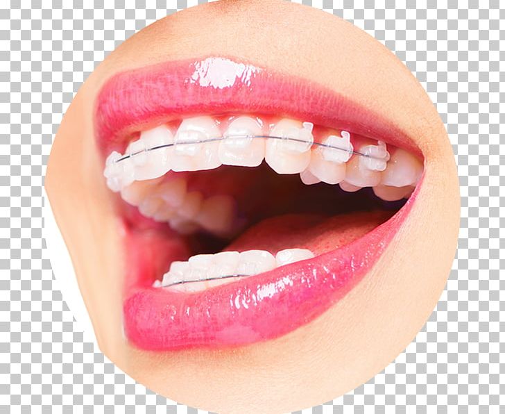Byfleet Dental Boutique Orthodontics Dentistry Dental Braces PNG, Clipart, Boutique, Braces, Byfleet, Clear Aligners, Cosmetic Dentistry Free PNG Download