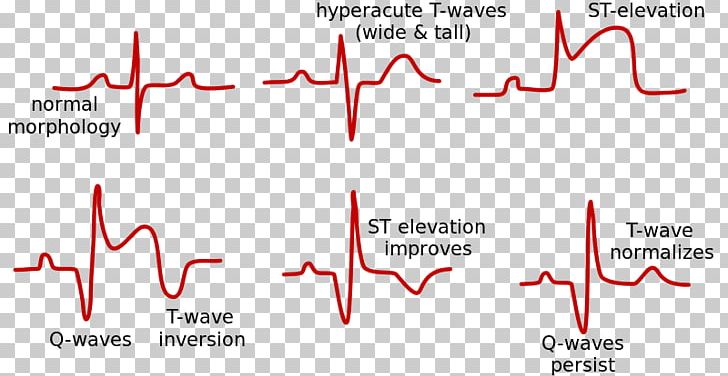 st segment elevation myocardial infarction
