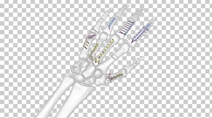 Hand Bone Fracture Synthes Metacarpal Bones Anatomy PNG, Clipart, Anatomy, Body Jewelry, Bone, Bone Fracture, Bones Free PNG Download