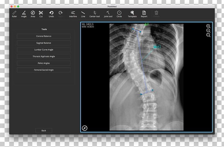 Scoliosis X-ray Vertebral Column Radiography Physical Therapy PNG, Clipart, Bruise, Chest Radiograph, Chiropractic, Injury, Jaw Free PNG Download