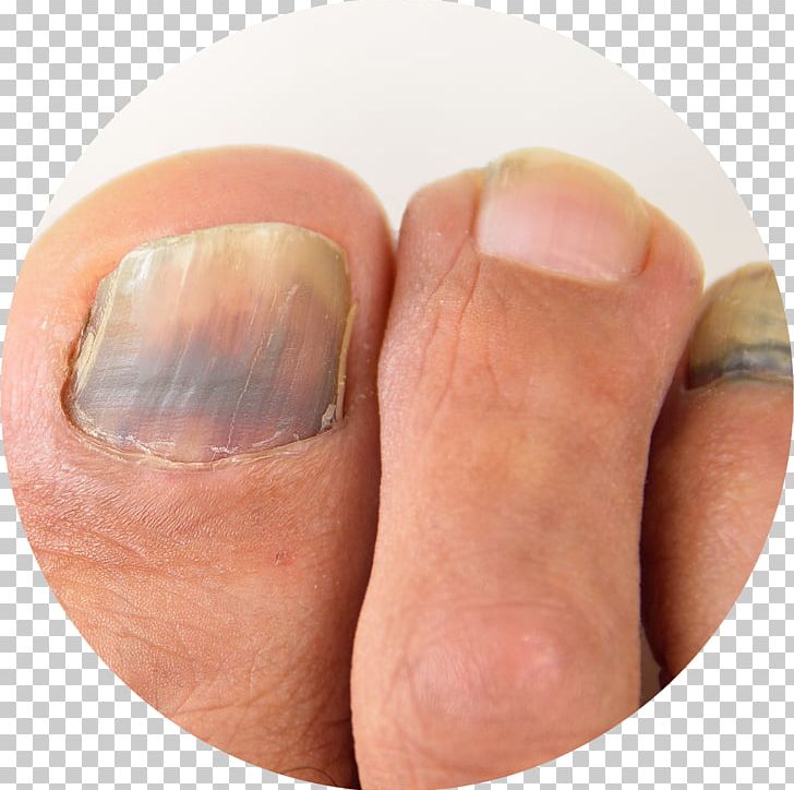 Nail Toe Foot Subungual Hematoma Hand PNG, Clipart, Blood, Dermatology, Finger, Foot, Hallux Free PNG Download