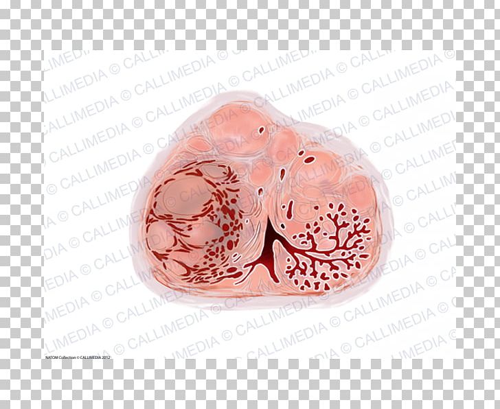 Benign Prostatic Hyperplasia Prostate Cancer Hypertrophy Transurethral Resection Of The Prostate PNG, Clipart, Anatomy, Benign Tumor, Fashion Accessory, Gemstone, Genitourinary System Free PNG Download
