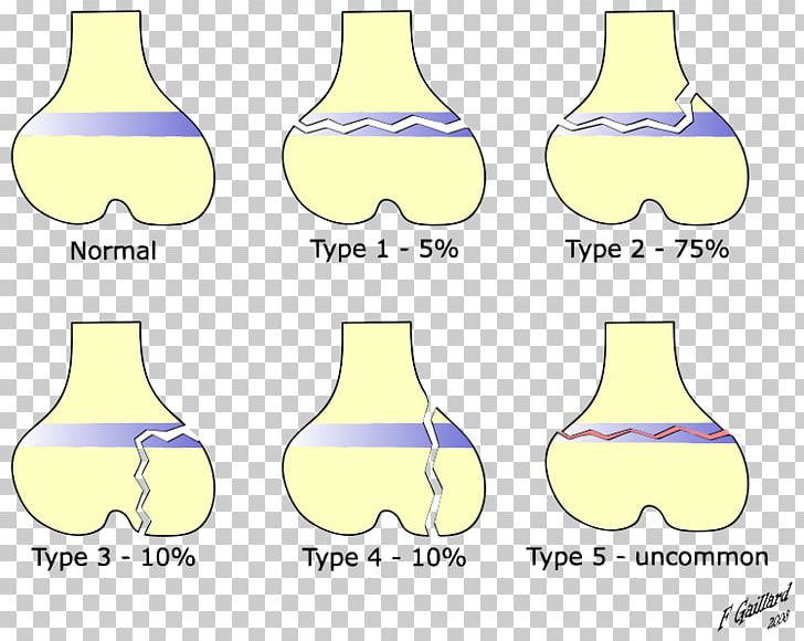 Salter–Harris Fracture Bone Fracture Ankle Fracture Injury Epiphyseal Plate PNG, Clipart, Ankle Fracture, Area, Bone, Bone Fracture, Epiphyseal Plate Free PNG Download