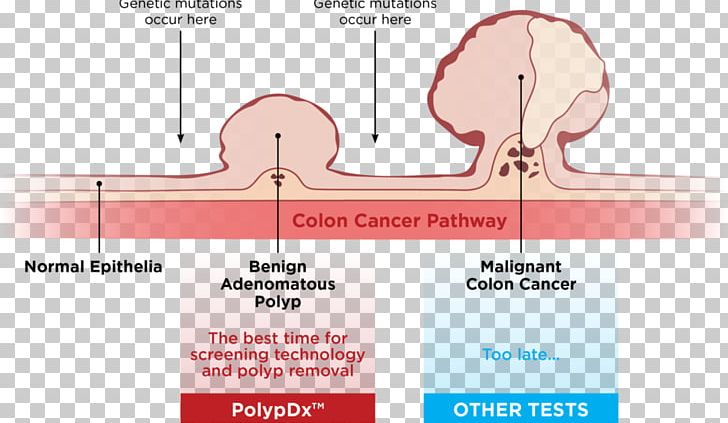 Colorectal Polyp Colorectal Cancer Adenoma Cancer Screening PNG, Clipart, Adenoma, Angle, Area, Cancer, Cancer Screening Free PNG Download