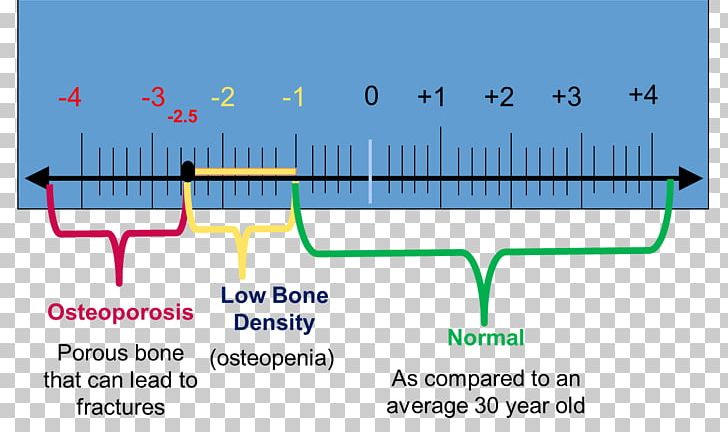 Bone Density Dual-energy X-ray Absorptiometry Osteopenia Densitometry ...