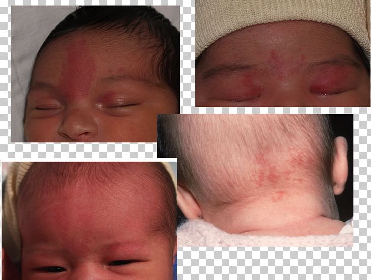 Nevus Flammeus Nuchae Infant Birthmark Nevus Sebaceous Sebaceous Gland PNG, Clipart, Birthmark, Cheek, Child, Chin, Closeup Free PNG Download