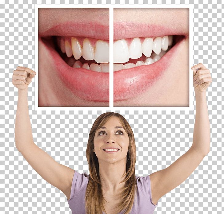 Tooth Whitening Dentistry Human Tooth PNG, Clipart, Bridge, Cadcam Dentistry, Chin, Color, Cosmetic Dentistry Free PNG Download