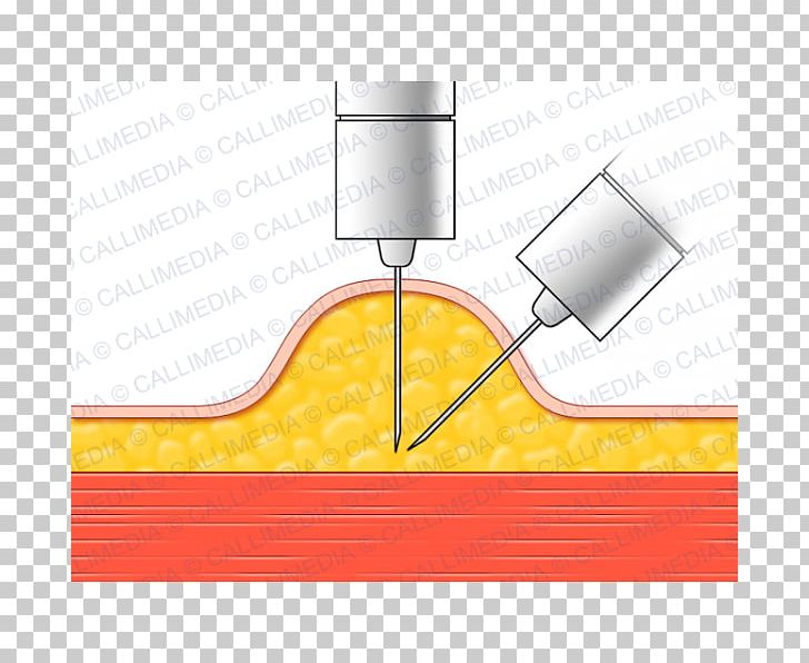 Subcutaneous Injection Endocrinology Diabetes Mellitus Diabetology PNG, Clipart, Anatomy, Angle, Arm, Complication, Diabetes Mellitus Free PNG Download