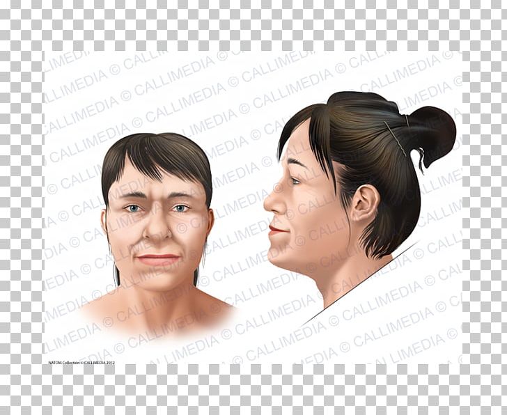 Acromegaly Face Symptom Skull Bossing Gigantism PNG, Clipart, Acromegaly, Cheek, Chin, Clinic, Ear Free PNG Download