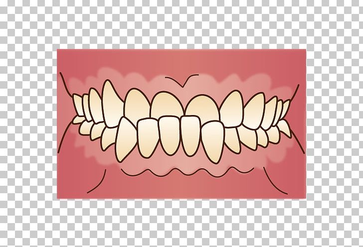 Crossbite Prognathism 歯科 Malocclusion Dentist PNG, Clipart, Alaleuanluu, Crossbite, Dental Braces, Dental Surgery, Dentist Free PNG Download