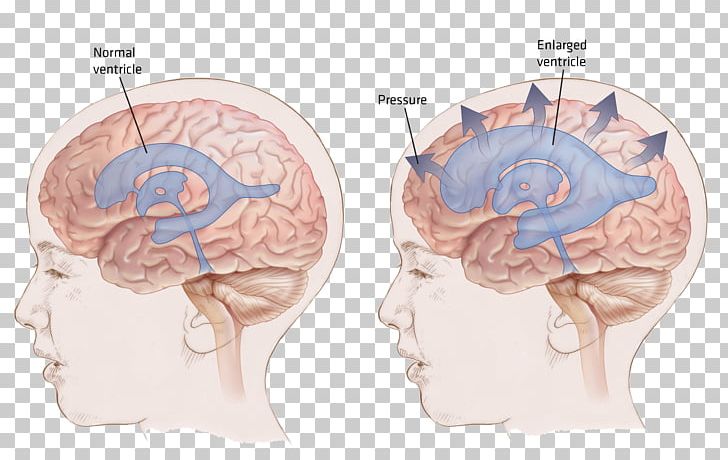 Ventricular System Normal Pressure Hydrocephalus Shunt Brain PNG, Clipart, Cause, Ear, Fourth Ventricle, Head, Hearing Free PNG Download
