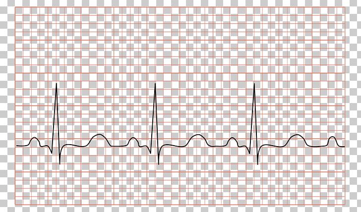 Ventricular Tachycardia Electrocardiography Sinus Tachycardia Heart PNG, Clipart, Angle, Area, Bradycardia, Diagram, Ecg Free PNG Download