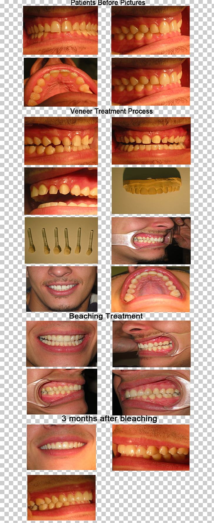 Veneer Dentistry Dental Porcelain Tooth PNG, Clipart, Dental Porcelain, Dentist, Dentistry, Human Tooth, Kapshtica Renis Dds Free PNG Download