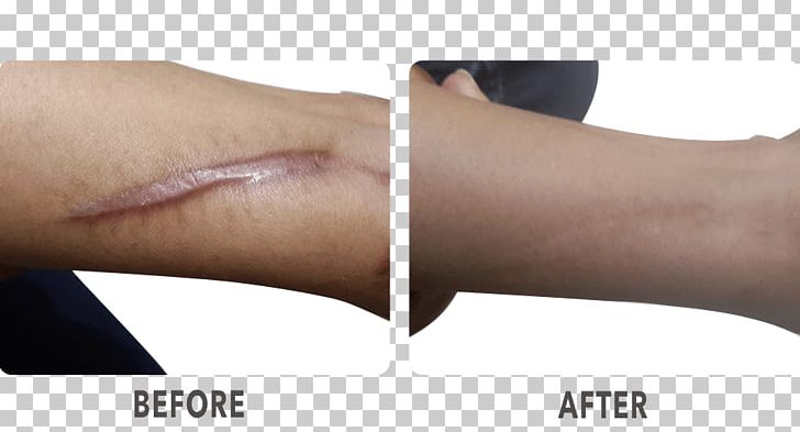 Nail Surgery Scar La Skinnovita PNG, Clipart, Arm, Chin, Collagen Induction Therapy, Dermatology, Finger Free PNG Download