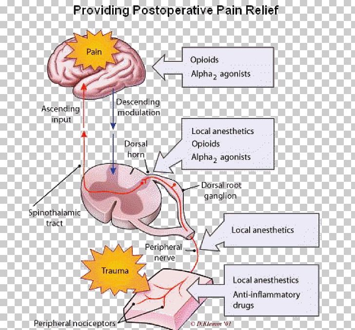 Acute Pain Management Chronic Pain Analgesic PNG, Clipart, Analgesic, Anesthesiology, Angle, Area, Chronic Pain Free PNG Download