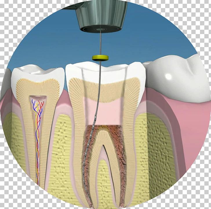 Endodontic Therapy Dentistry Human Tooth Pulp PNG, Clipart, Clinic, Dental Composite, Dental Extraction, Dentist, Dentistry Free PNG Download