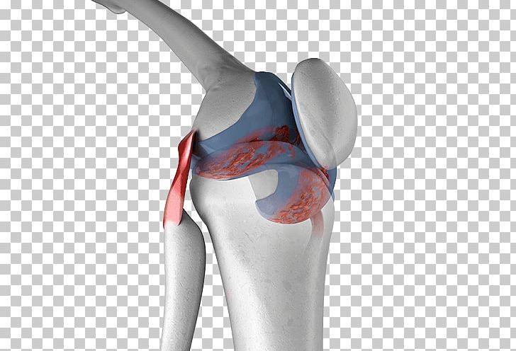Knee Pain Arthritic Pain Knee Arthritis Joint PNG, Clipart, Arm, Arthritis, Articular Cartilage Damage, Hip, Joint Free PNG Download