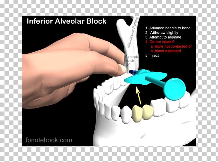 Inferior Alveolar Nerve Anaesthesia Posterior Superior Alveolar Nerve Mandibular Nerve Nerve Block PNG, Clipart, Advertising, Dentistry, Hand, Incisor, Inferior Alveolar Artery Free PNG Download