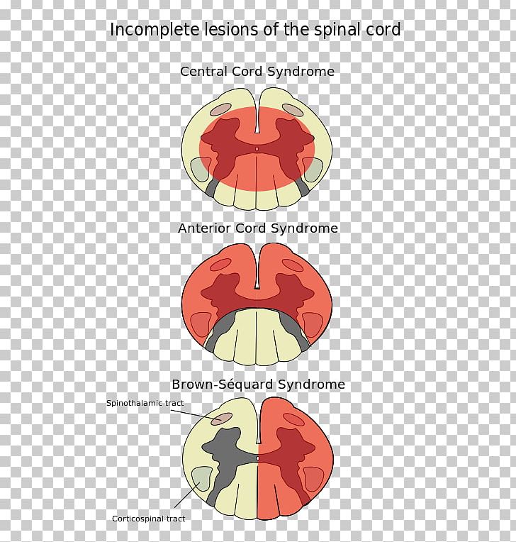 Spinal Cord Injury Anterior Spinal Artery Syndrome Central Cord Syndrome PNG, Clipart, Anterior Spinal Artery, Diagram, Injury, Joint, Lesion Free PNG Download