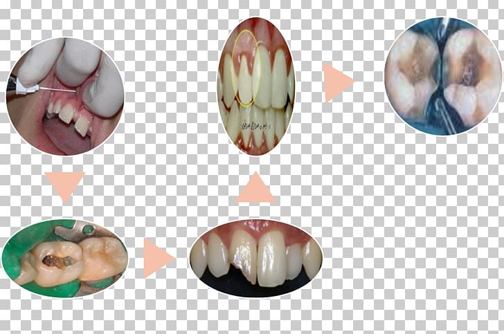 Endodontic Therapy Root Canal Dentistry Ya Lo Sabemos Pulp PNG, Clipart, Anatomy, Chronicle, Dentistry, Education, Endodontic Therapy Free PNG Download