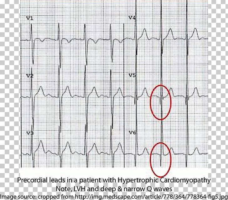 Hypertrophic Cardiomyopathy Electrocardiography Syncope Cardiac Arrest PNG, Clipart, Angle, Area, Cardiac Arrest, Cardiology, Cardiomyopathy Free PNG Download