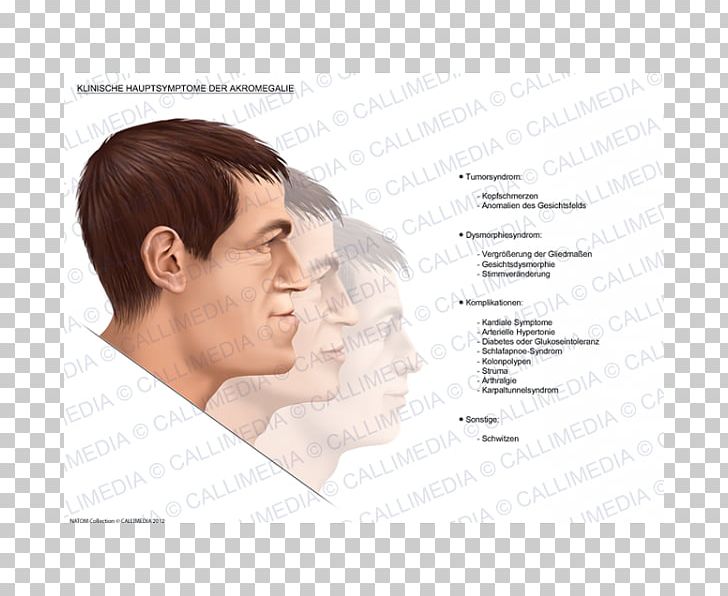Nose Acromegaly Symptom Pituitary Gland Medical Sign PNG, Clipart,  Free PNG Download