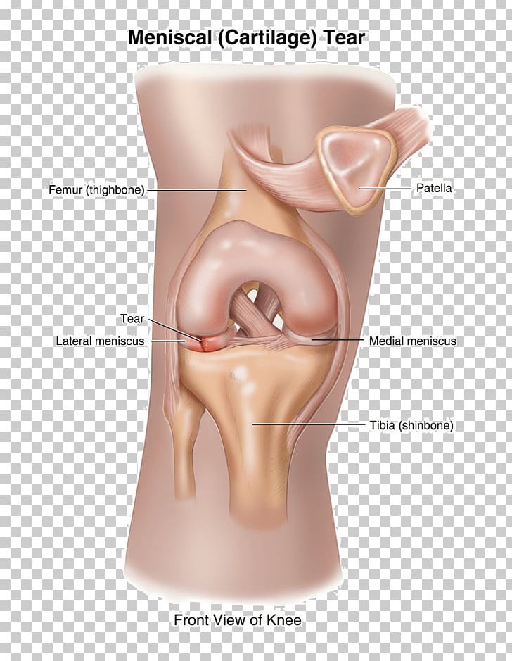 Tear Of Meniscus Knee Pain Ruptur PNG, Clipart,  Free PNG Download