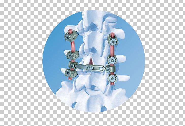 Vertebral Column DePuy Synthes Companies Osteosynthesis Spinal Cord Vertical Expandable Prosthetic Titanium Rib PNG, Clipart, Arthrodesis, Depuy Synthes Companies, Joint, Orthopaedics, Osteosynthesis Free PNG Download
