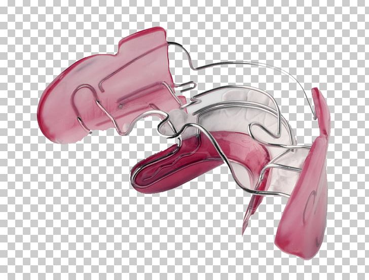 Orthodontics Orthodontic Technology Dental Braces Dentistry Retainer PNG, Clipart, Crossbite, Dental Braces, Dentistry, Eyewear, Fashion Accessory Free PNG Download