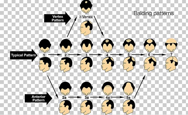 Pattern Hair Loss Alopecia Areata Hair Transplantation PNG, Clipart, Androgen, Beard, Brand, Capelli, Cartoon Free PNG Download