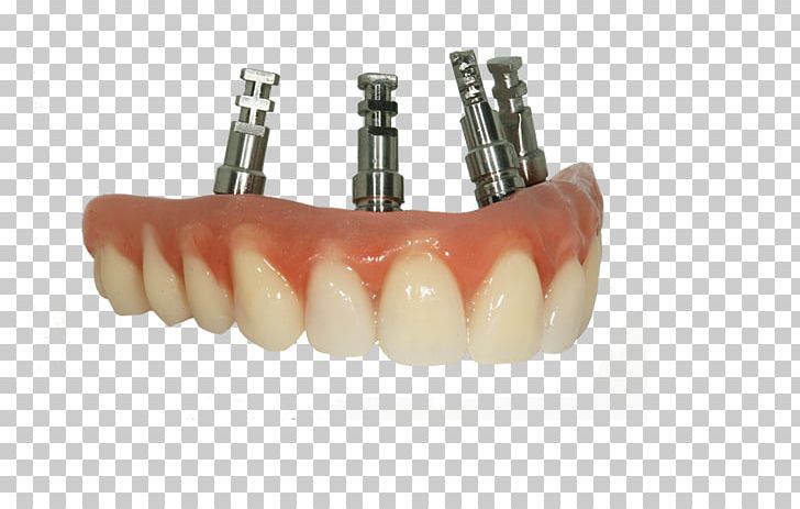 Bridge Tooth Dentures Prosthesis Dentistry PNG, Clipart, Bridge, Crown, Dental Implant, Dental Laboratory, Dentistry Free PNG Download