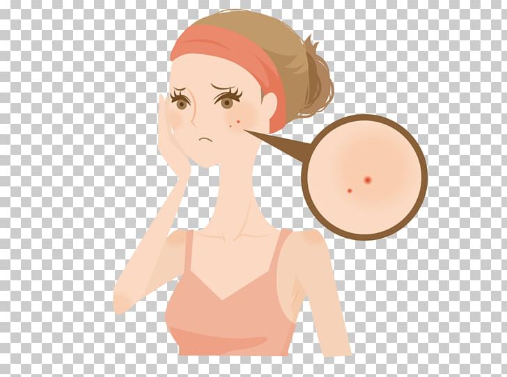 Acne Reinigungswasser Melasma Skin Androgen PNG, Clipart, Arm, Cheek, Dermatology, Ear, Face Free PNG Download