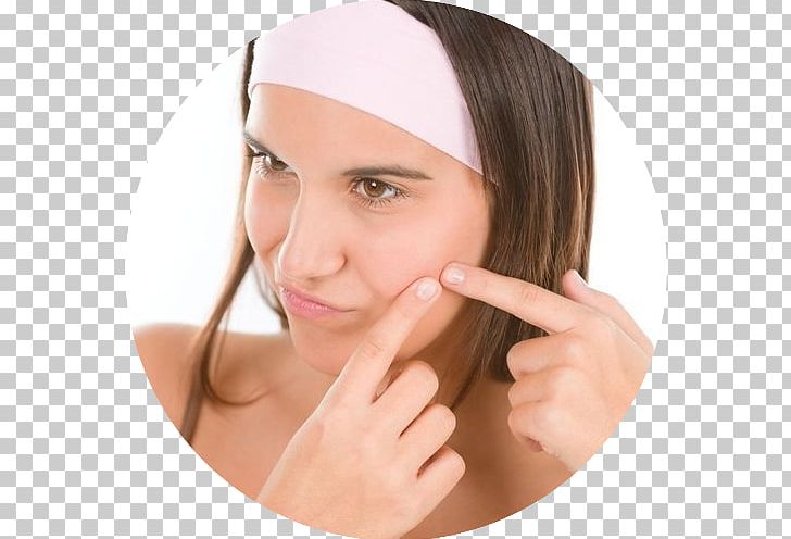 Acne Pimple Scar Skin Care Tretinoin PNG, Clipart, Acne, Beauty, Cause, Cheek, Chin Free PNG Download