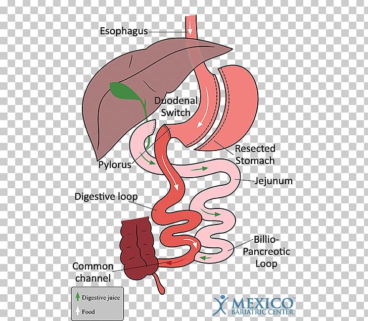 Duodenal Switch Gastric Bypass Surgery Bariatric Surgery Sleeve Gastrectomy Duodenum PNG, Clipart,  Free PNG Download
