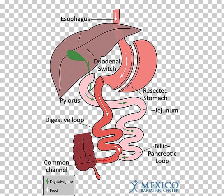 duodenal cap image clipart