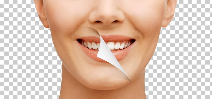 Tooth Whitening Dentistry Human Tooth Bleach PNG, Clipart, Bleach, Cartoon, Cheek, Chin, Closeup Free PNG Download