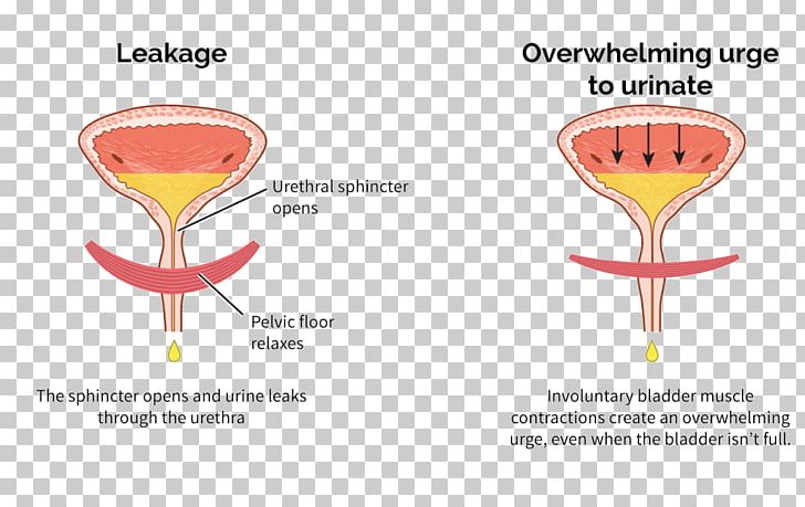 Overactive Bladder Urinary Bladder Urinary Incontinence Urethral Sphincters PNG, Clipart, Bladder, Cause, Diagram, Drinkware, Kidney Free PNG Download