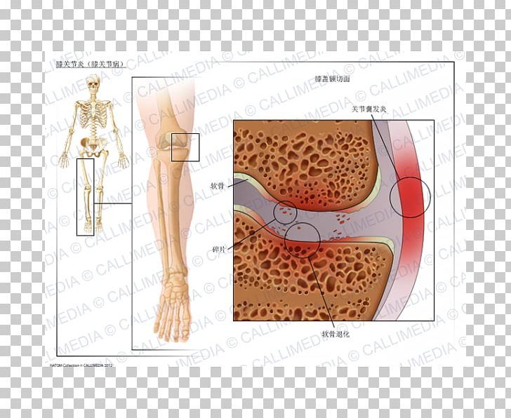 Knee Arthritis Knee Osteoarthritis PNG, Clipart, Abdomen, Arm, Arthritis, Arthropathy, Articular Cartilage Damage Free PNG Download