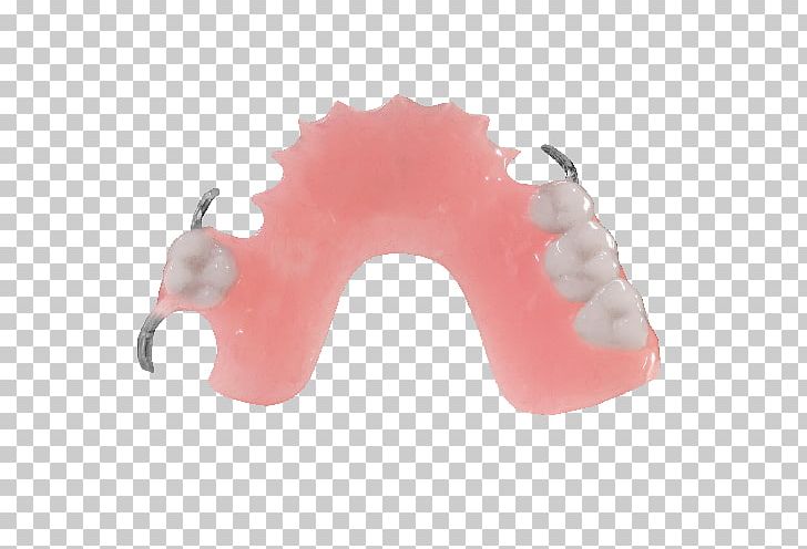 Dentures Removable Partial Denture Dentistry Dental Laboratory Jaw PNG, Clipart, Allure Dental Lab, Clasp, Clinic, Cosmetic, Cosmetic Dentistry Free PNG Download