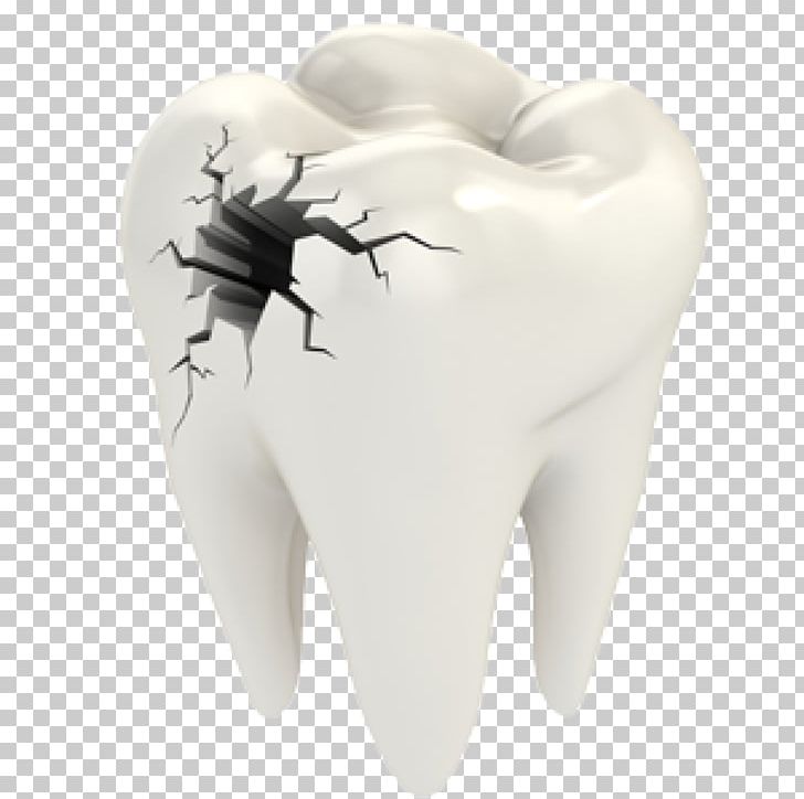 Cracked Tooth Syndrome Dentistry Dental Restoration Human Tooth PNG, Clipart, Bone Fracture, Cracked Tooth Syndrome, Dental Restoration, Dentist, Dentistry Free PNG Download