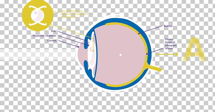Cataract Surgery Intraocular Lens Merck Group PNG, Clipart, Area, Artificial, Brand, Cataract, Cataract Surgery Free PNG Download