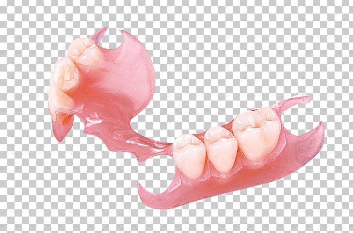 Removable Partial Denture Dentures Dentistry Crown PNG, Clipart, Bridge, Cadcam Dentistry, Crown, Dental Arch, Dental Laboratory Free PNG Download