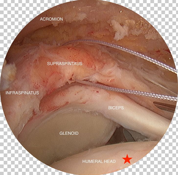 Rotator Cuff Tear Supraspinatus Muscle Arthroscopy Surgery PNG, Clipart, Arthroscopy, Closeup, Disease, Flesh, Forehead Free PNG Download