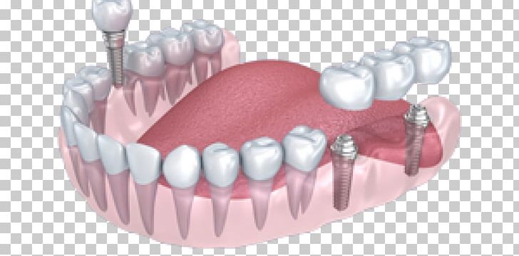 Tooth Dental Implant Dentistry Crown PNG, Clipart, Allon4, Crown, Dental, Dental Implant, Dentistry Free PNG Download