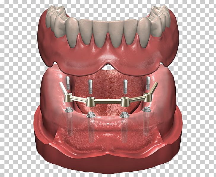 Dentures Dental Implant Prosthesis Dentist PNG, Clipart, Allon4, Bridge, Crown, Dental Implant, Dentist Free PNG Download