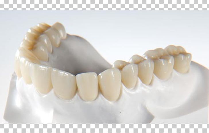 Crown Zirconium Dioxide CAD/CAM Dentistry Dental Laboratory PNG, Clipart, Bridge, Cadcam Dentistry, Crown, Dental Implant, Dental Laboratory Free PNG Download