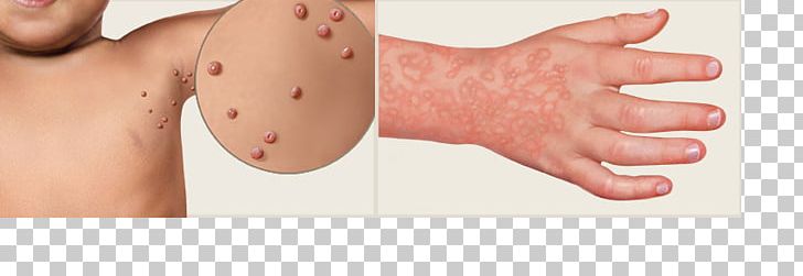 Exanthem Skin Rash Virus Morbilliform Fifth Disease PNG, Clipart, Abdomen, Arm, Celebrity, Cheek, Chest Free PNG Download